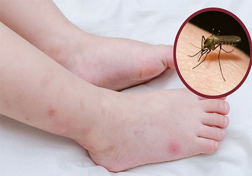 10 Cách trị vết thâm muỗi đốt nhanh nhất