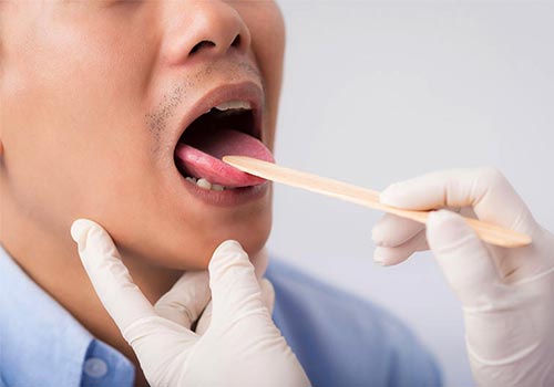 10 Hình ảnh loét lưỡi Apthae và cách trị