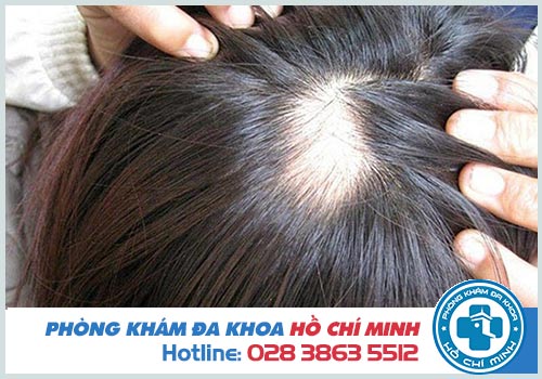 12 Địa chỉ chữa rụng tóc uy tín hiệu quả tại TPHCM