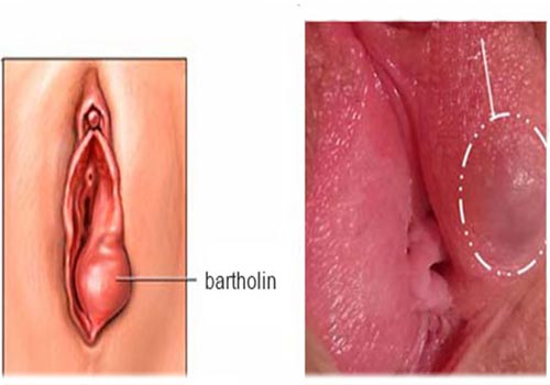 4 Cách trị viêm tuyến bartholin tại nhà