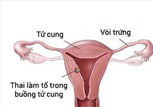 6 Dấu hiệu thai đã làm tổ trong tử cung dễ nhận biết