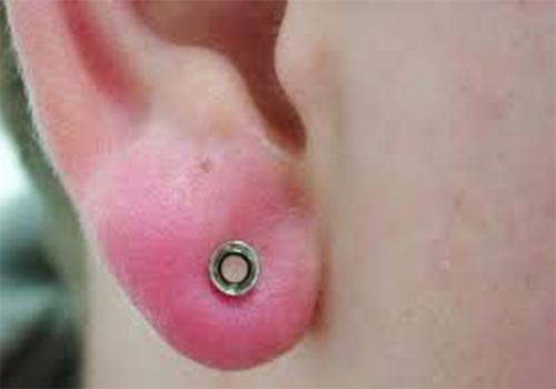 Bấm lỗ tai bị sưng mủ phải làm sao?