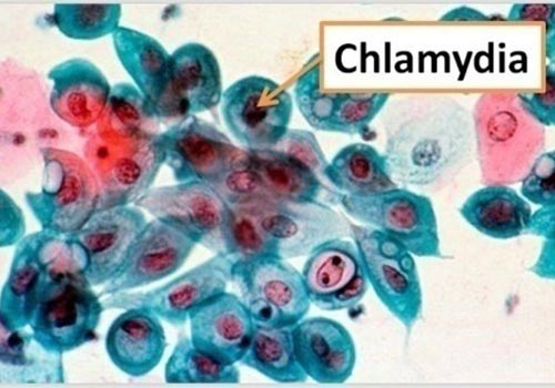 Bệnh Chlamydia là gì? Nguyên nhân, triệu chứng và thuốc trị