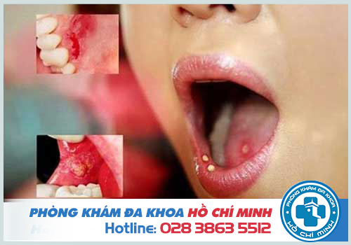 Bệnh lậu ở miệng: Nguyên nhân Dấu hiệu và Cách chữa trị hiệu quả