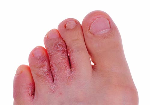 Bệnh nấm kẽ chân là gì? Nguyên nhân và cách chữa trị tại nhà