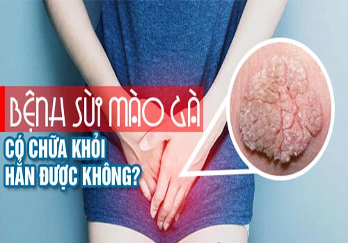 Bệnh sùi mào gà có chữa hẳn được không