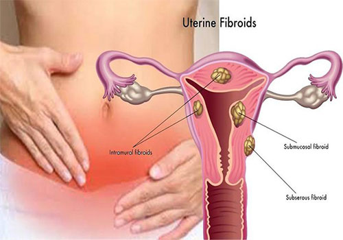 Bệnh u xơ tử cung là gì? Nguyên nhân, dấu hiệu và cách điều trị