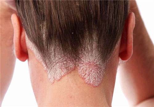 Bệnh vảy nến da đầu: Nguyên nhân, triệu chứng và dầu gội trị
