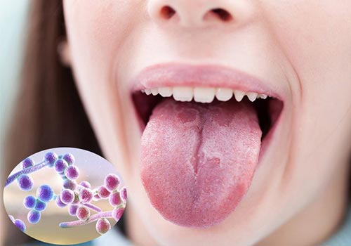 Bị rát lưỡi: nguyên nhân và cách điều trị hiệu quả