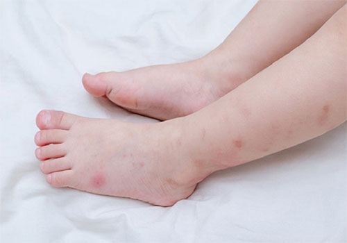 Chân nổi mẩn đỏ ngứa như muỗi đốt có sao không? Thuốc trị