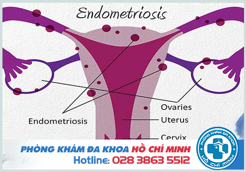 Có kinh nguyệt sớm hơn 10 ngày đến 15 ngày do bệnh lý phụ khoa