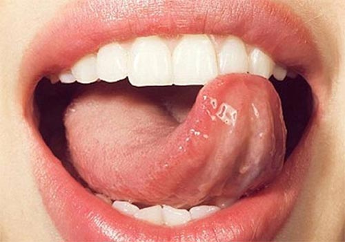 Cuống lưỡi nổi mụn thịt không đau là bị gì?