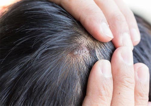Da đầu nổi mụn mủ chữa như thế nào?