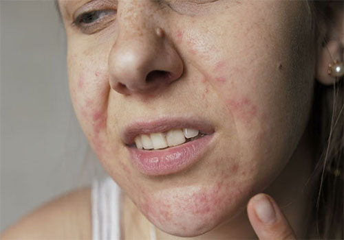 Da mặt bị ngứa và sần sùi là bị gì Cách chữa trị