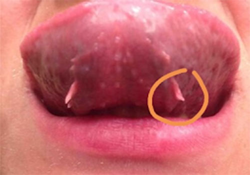 Dưới lưỡi có thịt dư là bệnh gì? Có nguy hiểm không?