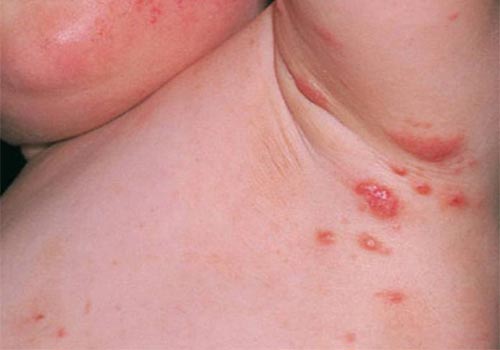 Ghẻ phỏng là bệnh gì? Nguyên nhân và cách chữa trị tại nhà