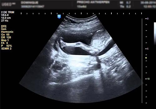 Hình ảnh bộ phận sinh dục thai nhi 15 tuần nhận biết trai gái