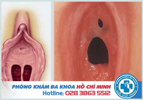 18 Hình ảnh Màng Trinh ĐÃ RÁCH và CHƯA RÁCH ở CON GÁI