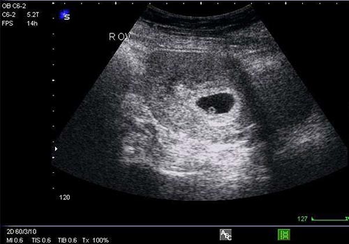 Hình ảnh siêu âm thai 5, 6, 7 tuần tuổi