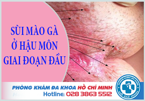 Hình ảnh sùi mào gà ở hậu môn qua từng giai đoạn của bệnh