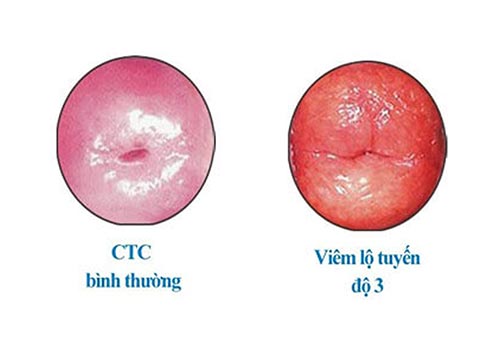 Hình ảnh viêm lộ tuyến cổ tử cung giai đoạn 4