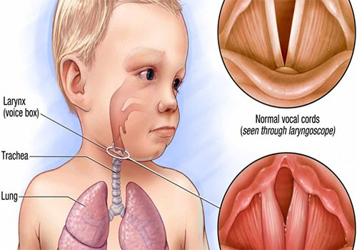 Hình ảnh viêm thanh quản