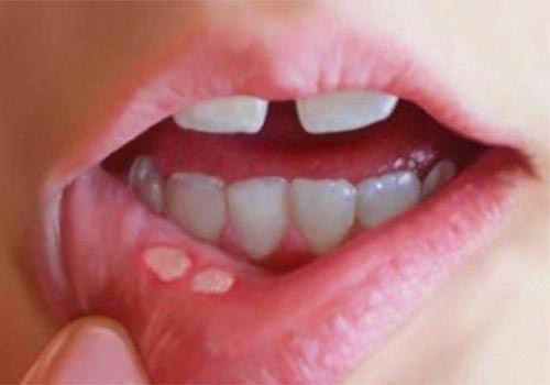 Hôn môi sâu có lây bệnh không? Có lây HIV không?