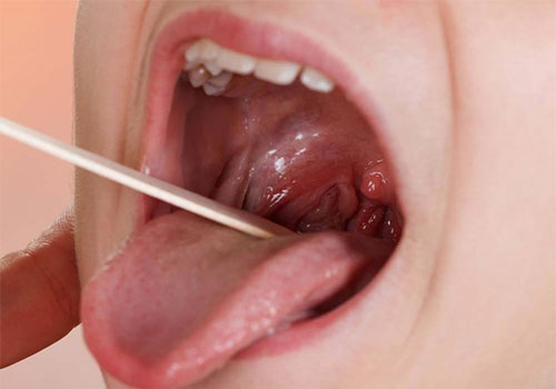 Khám lưỡi ở bệnh viện tai mũi họng có tốt không?