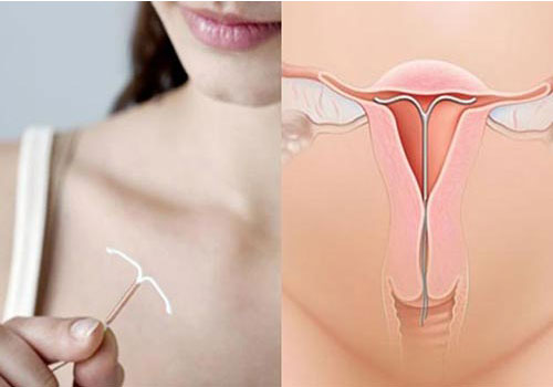 Kiểm tra vòng tránh thai bằng cách nào tại nhà?