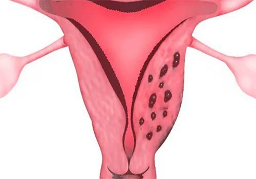 Lạc nội mạc tử cung là gì? Dấu hiệu và Cách điều trị