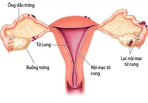 Triệu chứng của lạc nội mạc tử cung