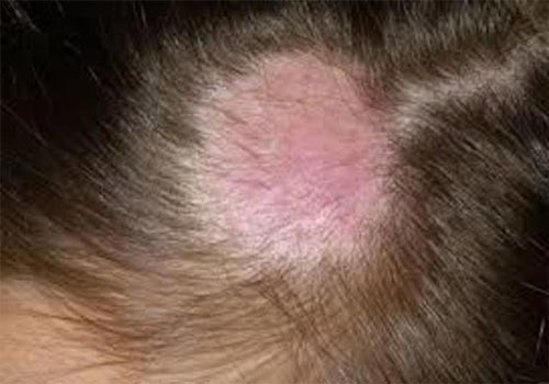 Loét da đầu: Nguyên nhân và Cách chữa trị