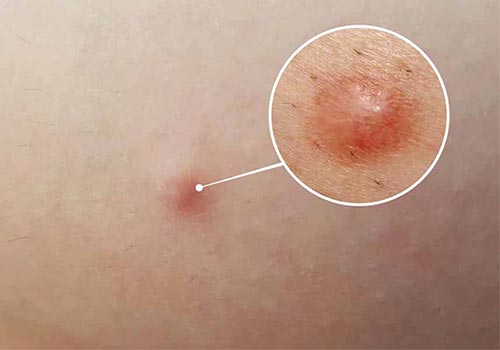 Mụn cục cứng dưới da: Hình ảnh và thuốc bôi trị