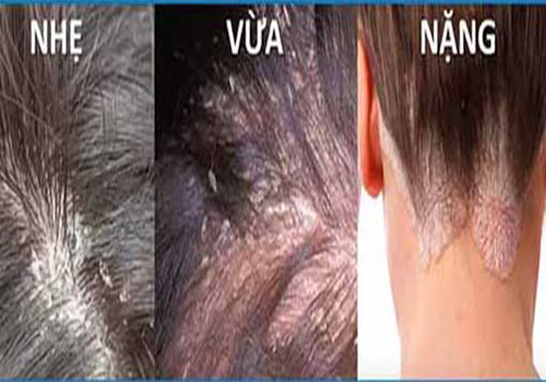 Nấm da đầu Nguyên nhân Triệu chứng Hình ảnh và Cách trị bệnh