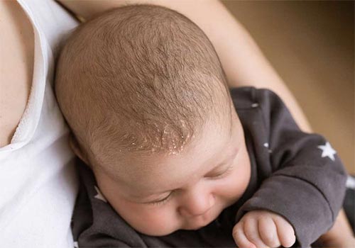 Nấm da đầu ở trẻ sơ sinh Nguy hiểm không? Cách chữa