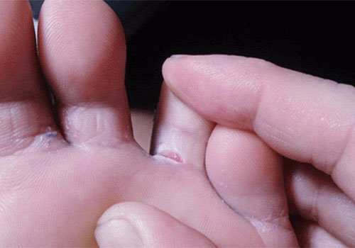 Ngứa kẽ ngón tay chân là bị gì? Cách chữa trị bệnh?