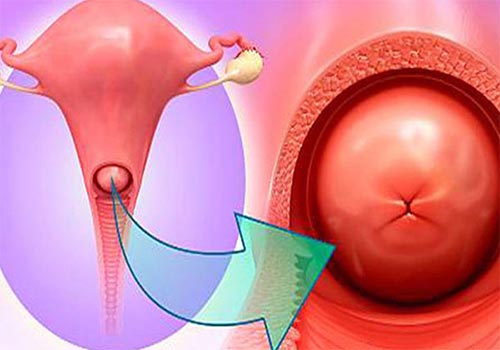 Nguyên nhân, triệu chứng và cách điều trị bệnh phì đại cổ tử cung