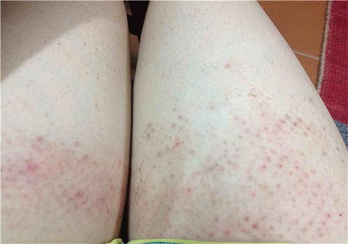 Nổi chấm đỏ dưới da ở chân không ngứa là bị gì? Cách trị