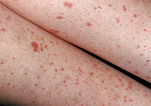 Nổi chấm đỏ dưới da ở chân không ngứa là bị gì? Cách trị