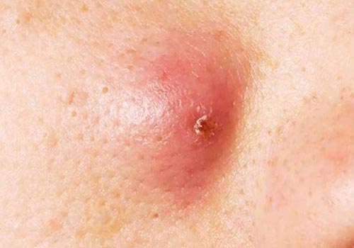 Nổi cục u cứng nhỏ dưới da mặt là bị gì? Cách trị