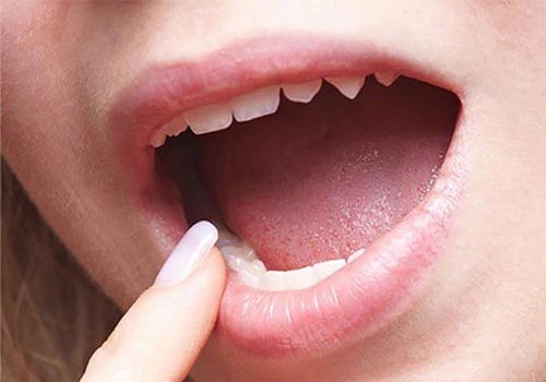Nổi đốm đỏ trong miệng là bị gì? Cách chữa trị?