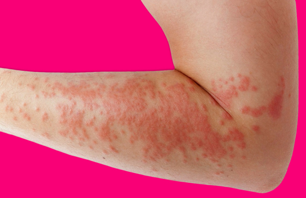 Bệnh Phong Lạnh Nổi Mề Đay Là Gì? Nguy Hiểm Không?