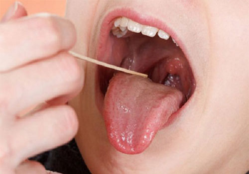 Nổi mụn nước trong vòm họng là bị gì? Cách chữa trị