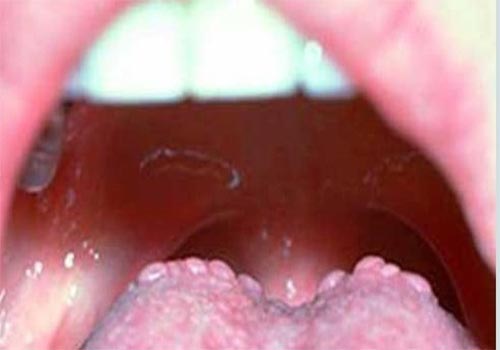 Nổi nhiều hạt ở cuống lưỡi là gì? Cách chữa trị TẠI NHÀ