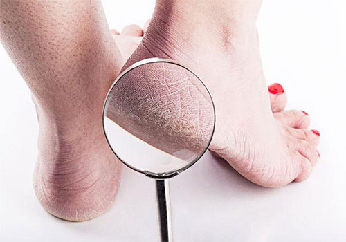 Nứt gót chân Nguyên nhân và Cách điều trị