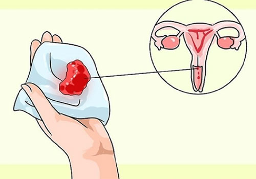 [ Tác Hại ] Tác dụng phụ của vòng tránh thai mà bạn nên biết 
