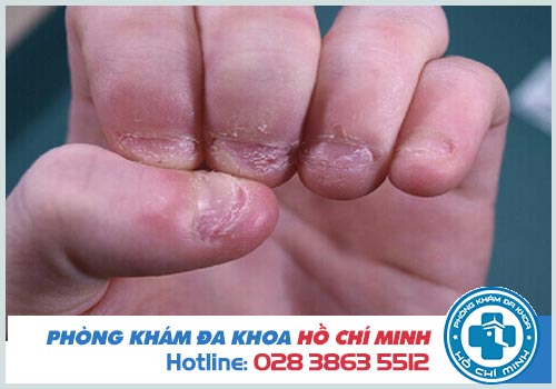 Thuốc trị nấm móng tay cho trẻ tại nhà an toàn và hiệu quả