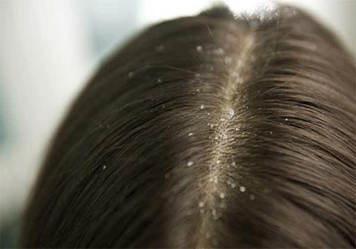 Tóc rụng có hạt trắng ở chân tóc là bị gì? Cách chữa trị