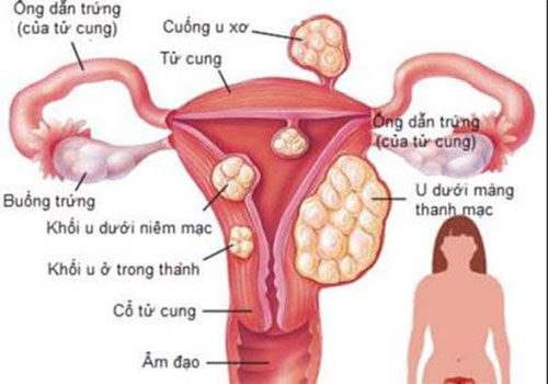 U nang tử cung là gì: Nguyên nhân Dấu hiệu và Cách chữa trị