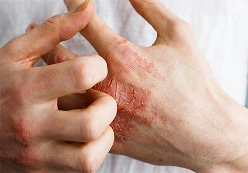 Viêm da tiếp xúc bội nhiễm có nguy hiểm không? Cách chữa trị